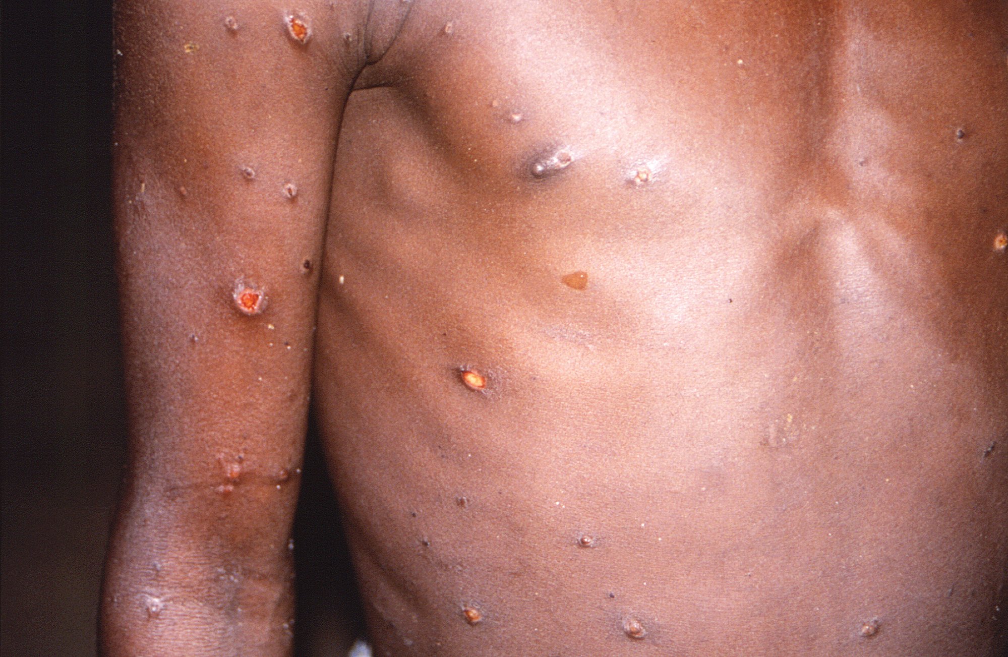 DHEC announces 1st confirmed cases of Monkeypox infection in Midlands,  Lowcountry | The Sumter Item